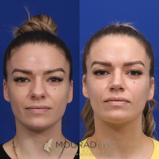 Facial Plastic Surgery