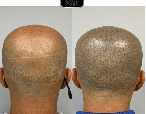 Micropigmentacion Capilar