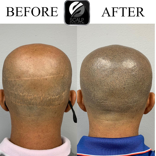 Micropigmentacion Capilar